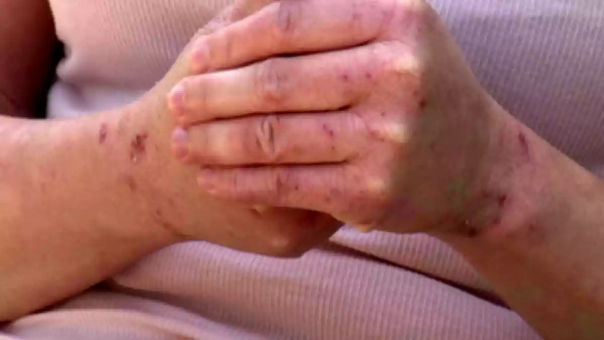 قلق من انتشار مرض جلدي "غريب" في الجزائر