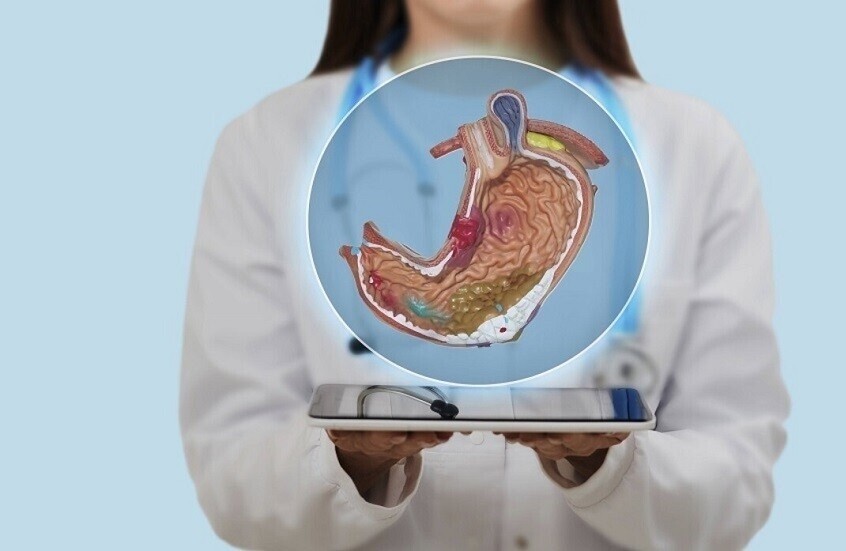 أطعمة تزيد خطر الإصابة بقرحة المعدة