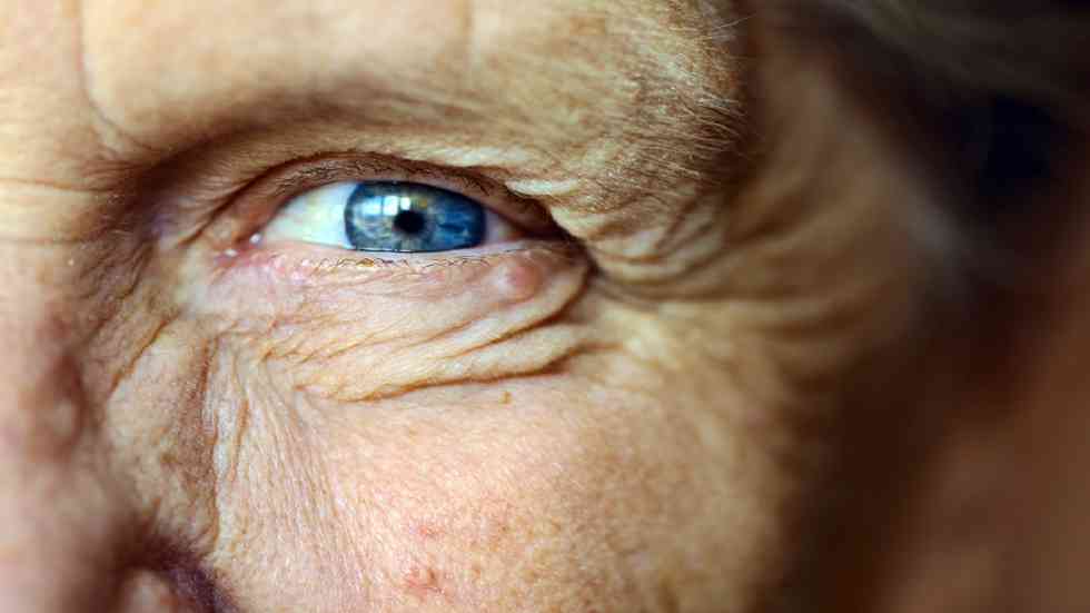 حالة شائعة في العين تهدد كبار السن بالعمى