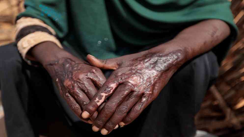 القتل على أساس عرقي يودي بحياة نحو 15 ألفا في السودان