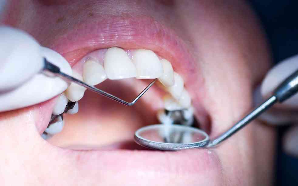 جديد الطب.. لقاح مضاد لتسوس الأسنان